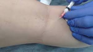 simptome de picior varicoase i tratament vene varicose rischi