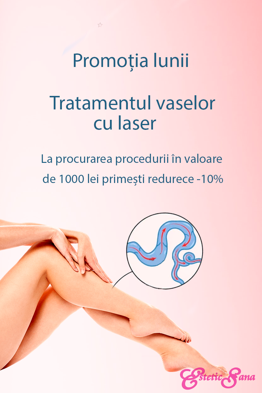 tratament_varice_clacs