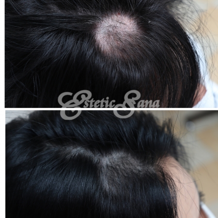 alopecie_tratament