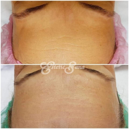 injectarea_cu_acid_hialuronic