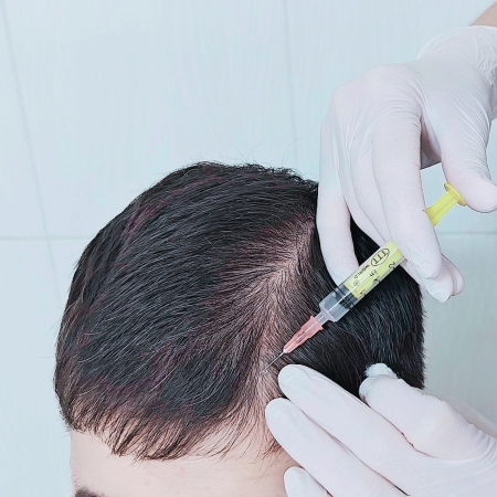 mezoterapie_scalp_chisinau_esteticsana